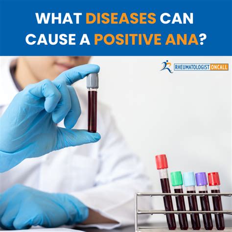 What diseases can cause a positive ana - In particular, patients with an IIM were more likely to be female, have a positive ANA, have interstitial lung disease, and have proximal, symmetric weakness. ... This suggests that patients with a large CK elevation without an obvious non-IIM cause can benefit substantially from rheumatologic evaluation.